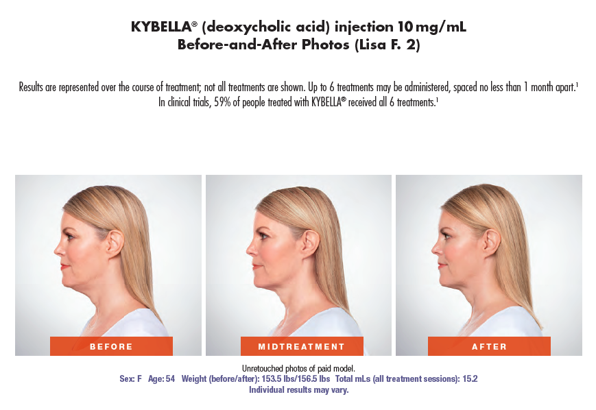 Get rid of double chin in Westminster, Co