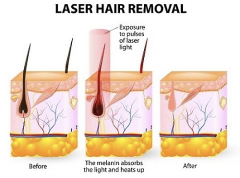 diagram showing the process of laser hair removal in Westminster