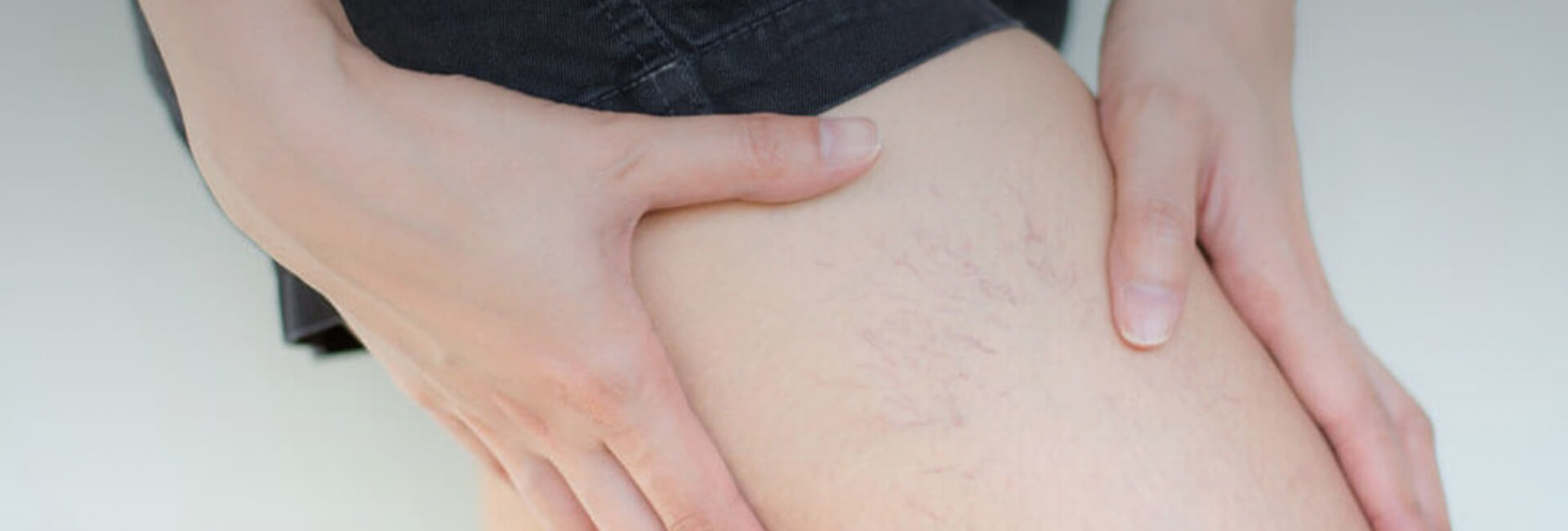 close up of a person showing the veins in their thigh 