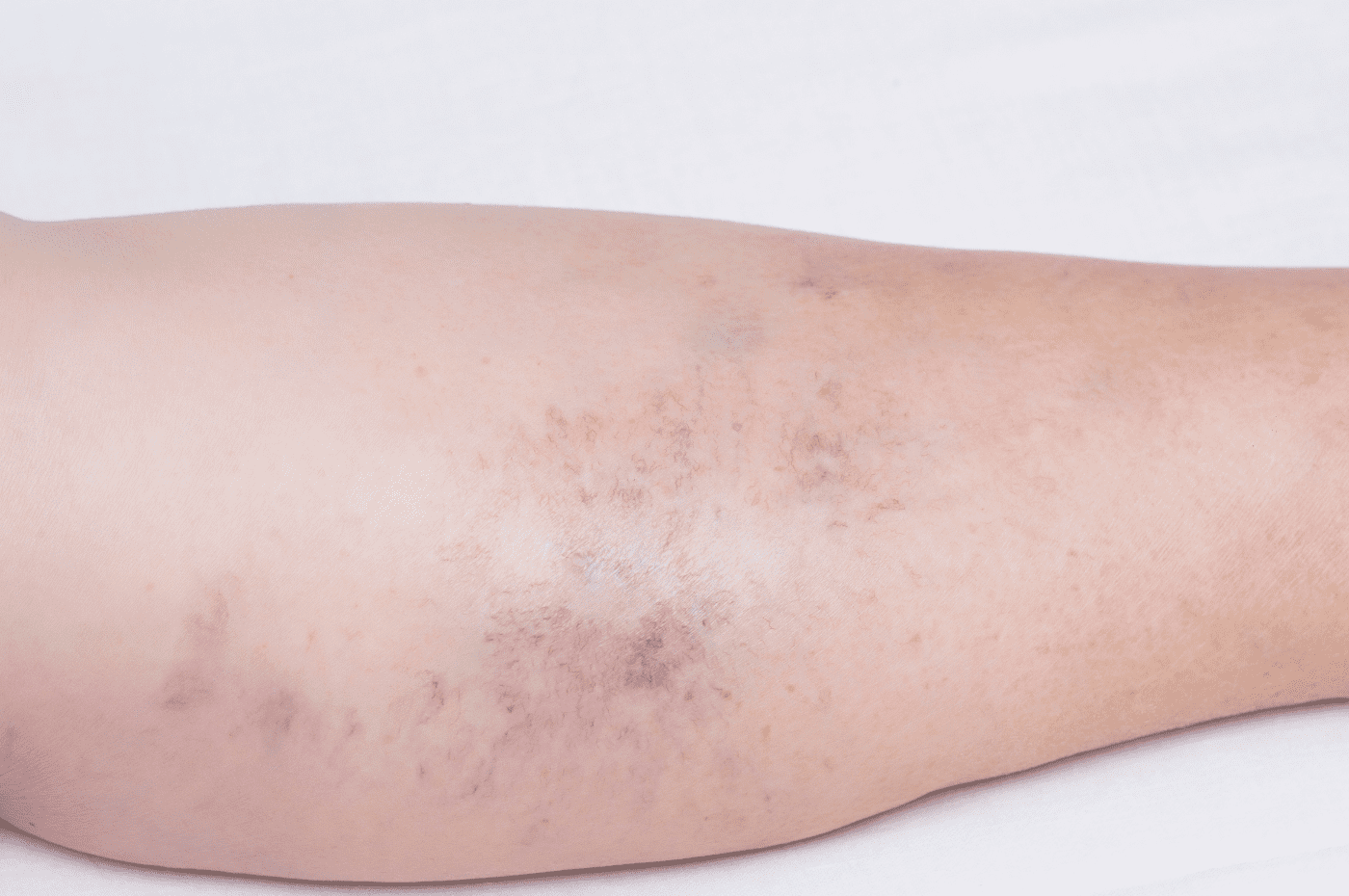 Venous insufficiency in Westminster, Co