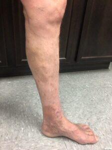 Vein ulcers treatment westminster