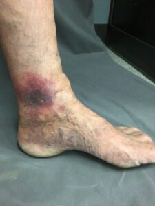 vein ulcers treatment westminster