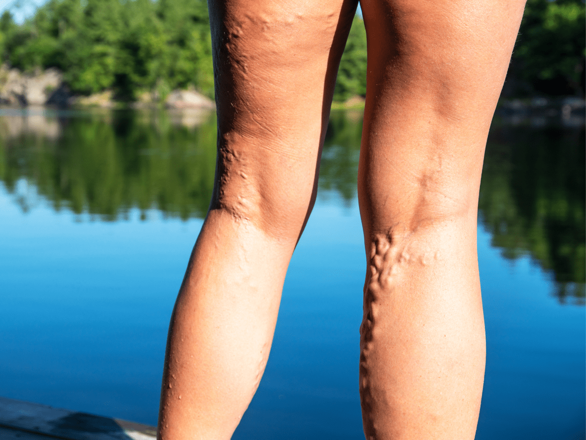 Understand the stages of varicose veins in westminster